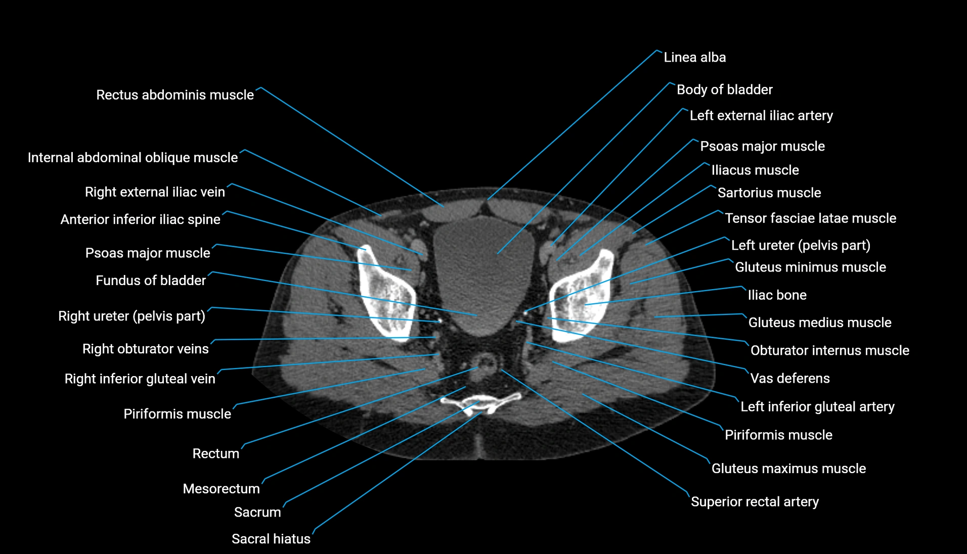 CT urogram axial cross sectional anatomy  labelled radiology image-00217.webp